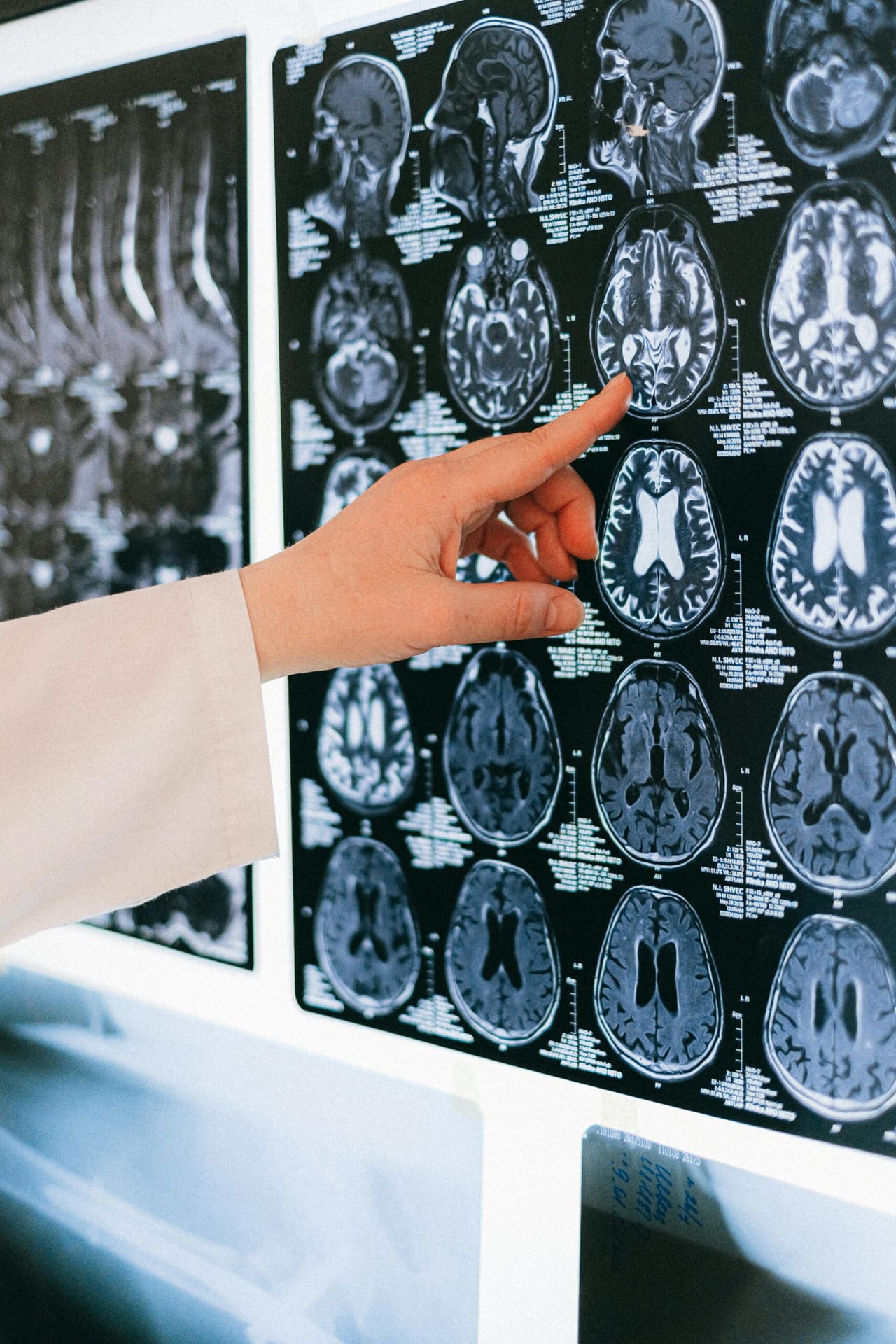 Neuralink Reaches Major Milestone: First Successful Human Brain-Computer Interface Implant