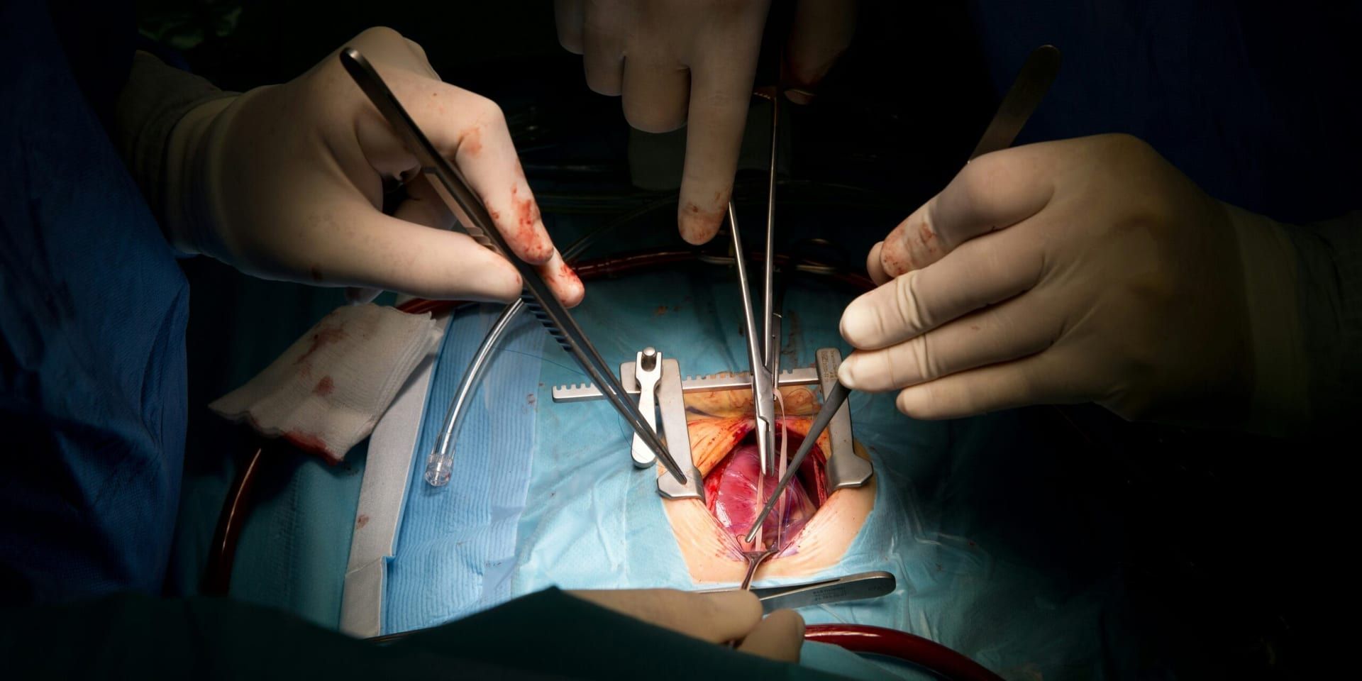 Scientists Map Human Immune Response to Pig Kidney Transplants