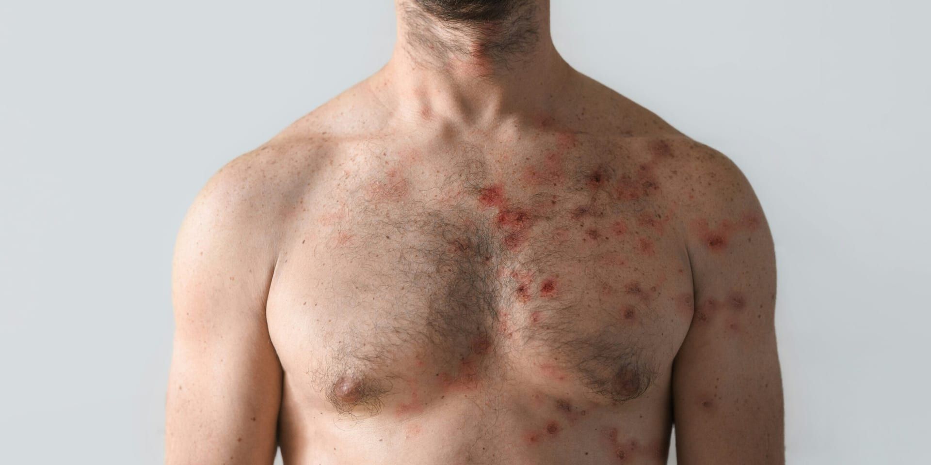 U.S. Health Officials Respond to Measles Outbreak Concerns