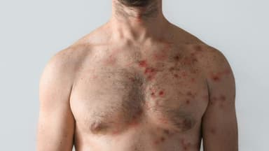 U.S. Health Officials Respond to Measles Outbreak Concerns